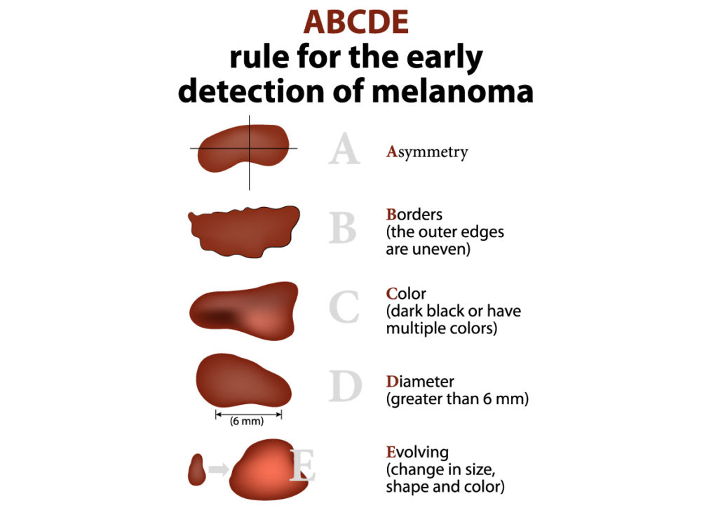 skin cancer ABCDE checklist