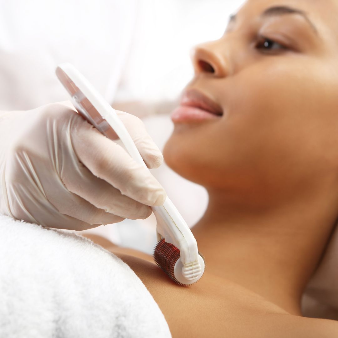 Microneedling