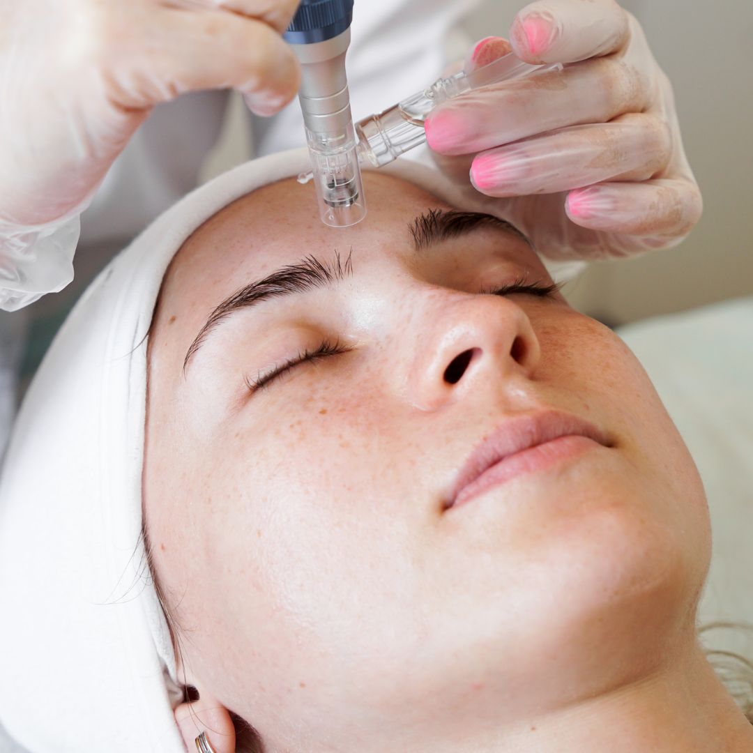 Microneedling

